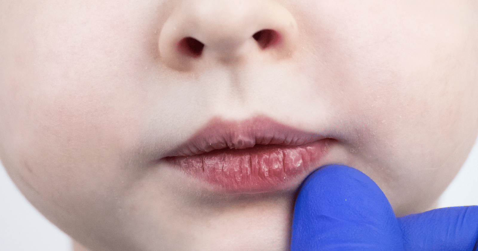 çocuklarda dudak morarması neden olur