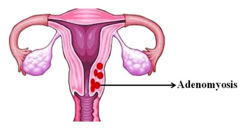 Adenomyozis Nedir? 1 Adenomyozis Nedir? 1