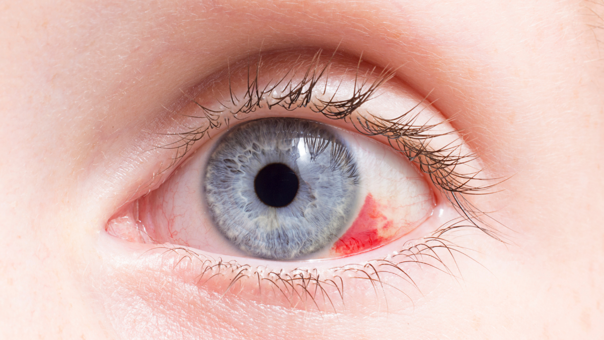 Hamilelikte Goz Kanlanmasi 1