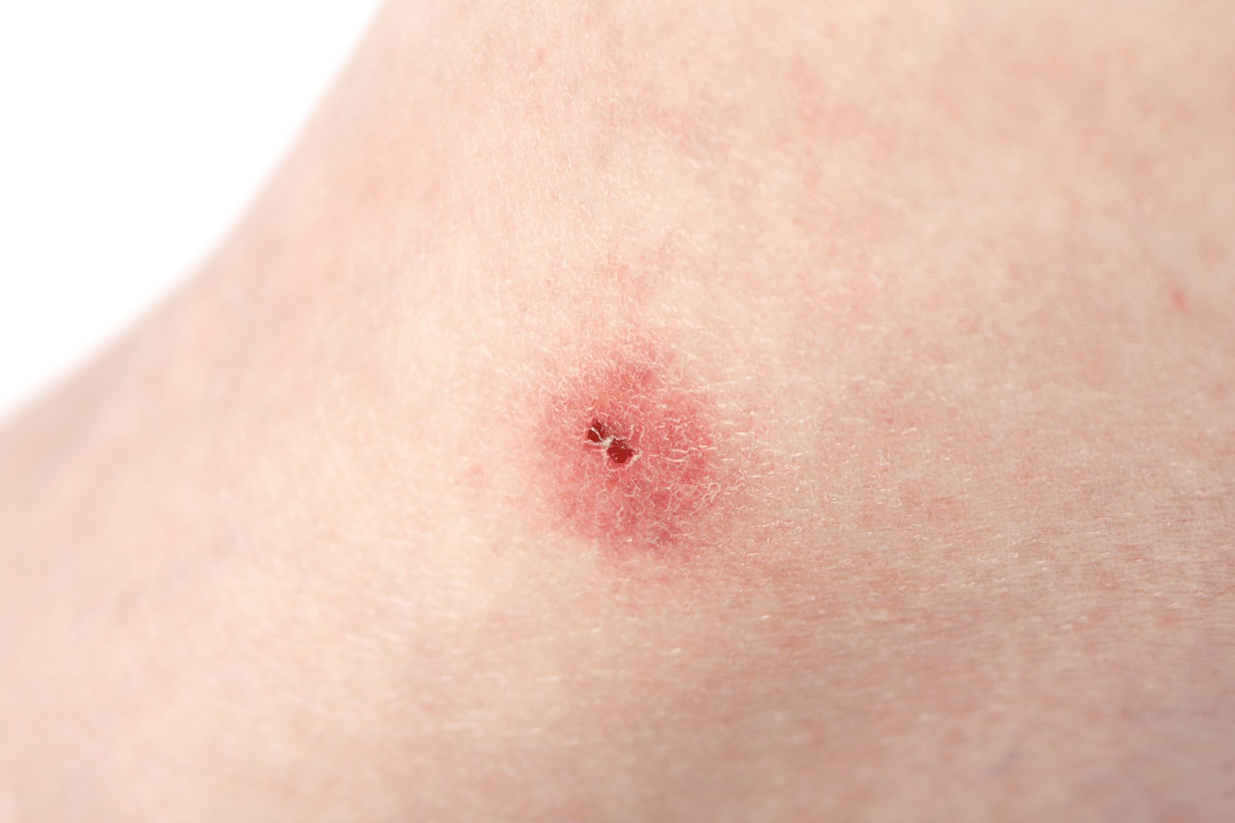 Hamilelikte Böcek Isırması