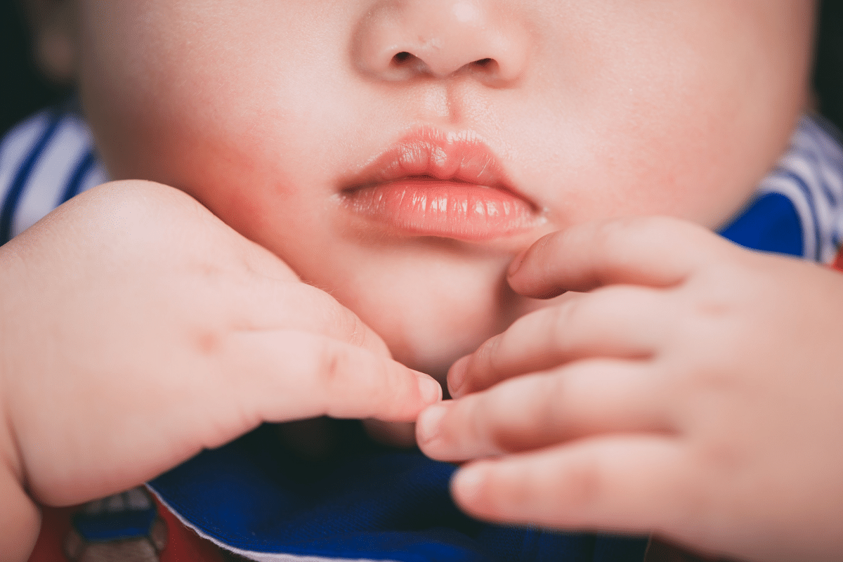 bebeklerde dudak yarasi olusumu belirtileri nelerdir 1