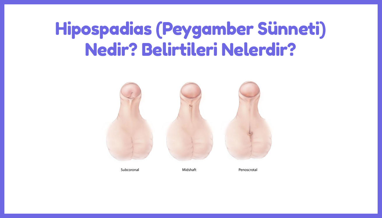 hipospadias nedir 1