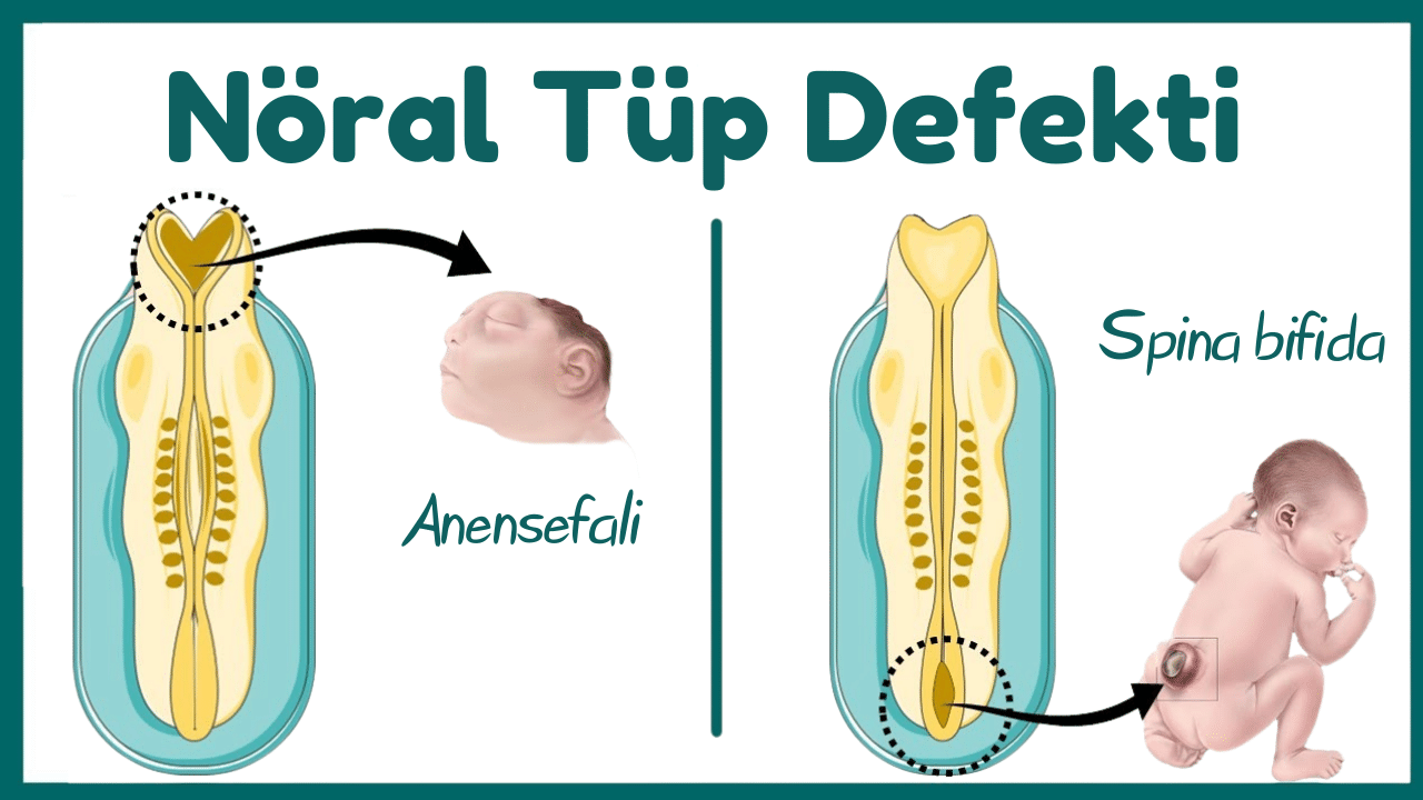 Nöral Tüp Defekti Nedir? Nöral Tüp Defekti Neden Olur?